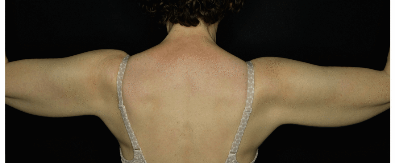 Let’s Talk About Bingo Wings – And What You Can Do About Them