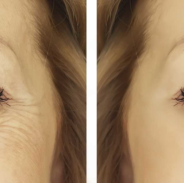 Anti Wrinkle Injections