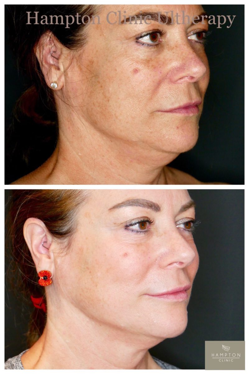 treatments - face - ultherapy -gallery b