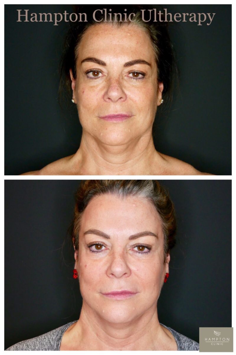 treatments - face - ultherapy -gallery c