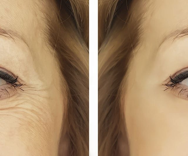 Blepharoplasty – Non-Surgical Eyelid Lifting