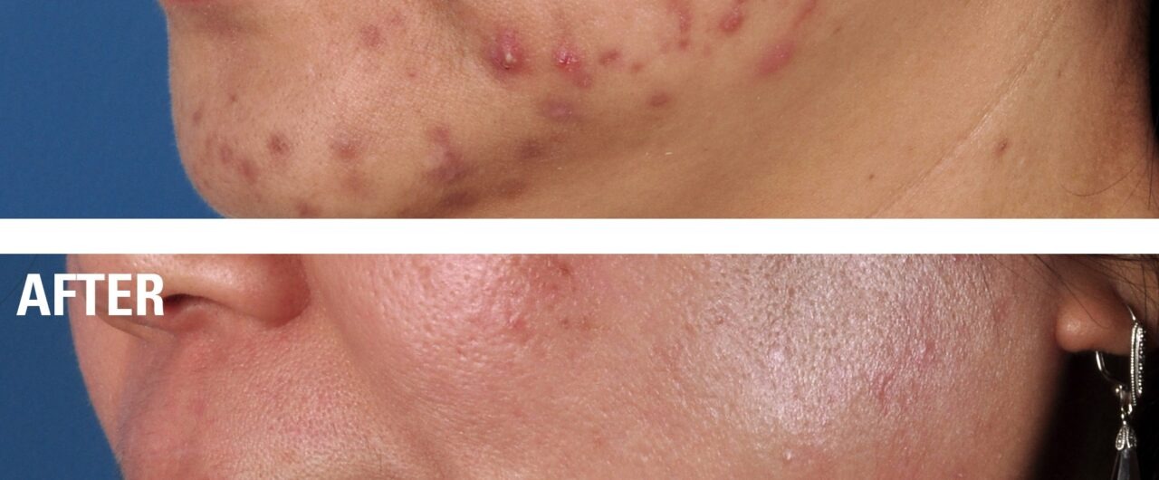 Acne Treatment and Prevention
