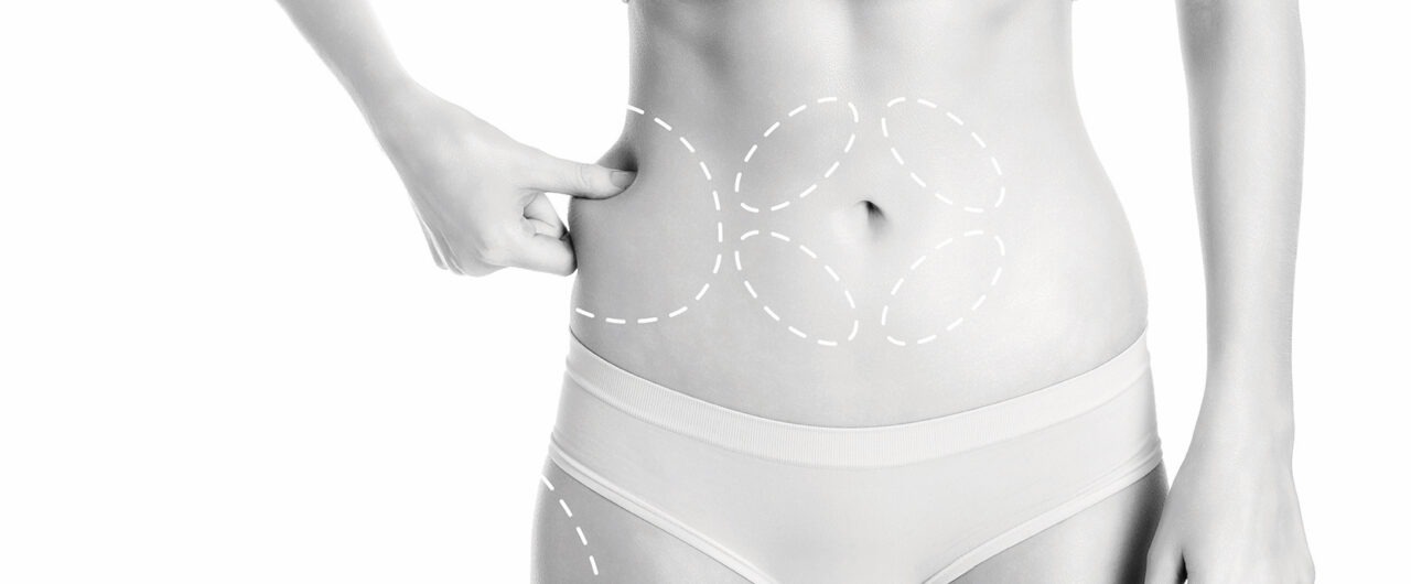 Coolsculpting Elite or Emsculpt Neo? What’s right for me?