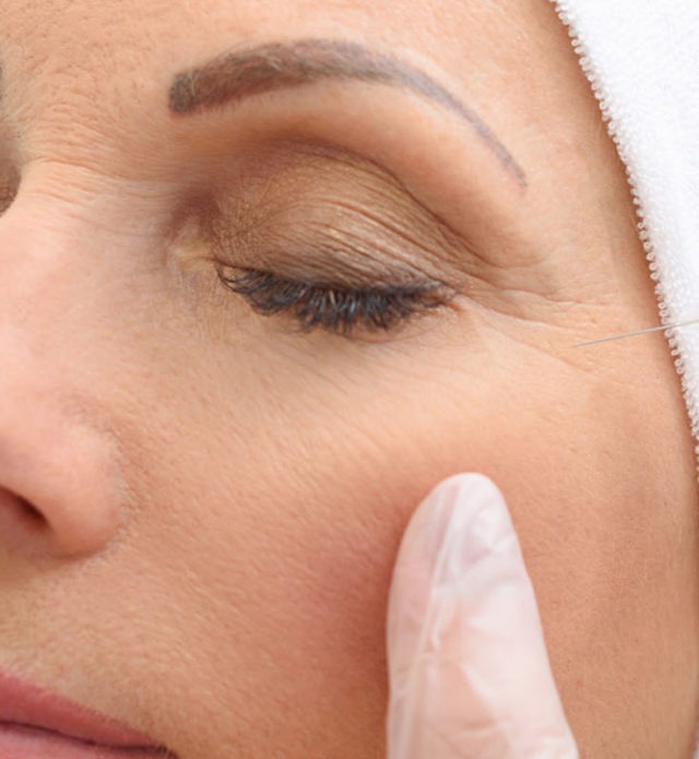 5 reasons to consider Botox