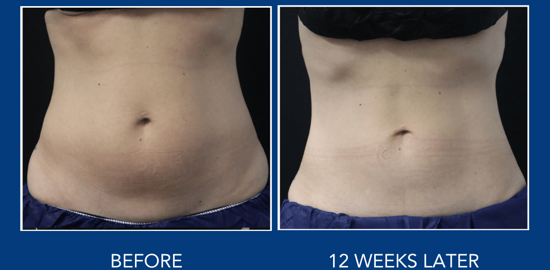 Why is Coolsculpting so popular?