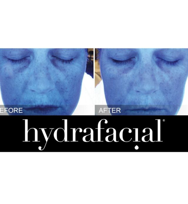 Why is Summer the perfect time to start having Hydrafacials?