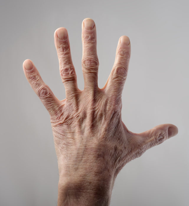 What can we do about ageing hands?