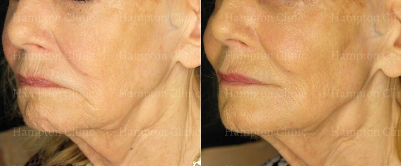 Direct from Dr Hill – dermal filler to reverse facial ageing