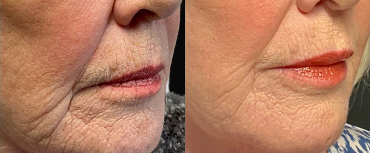 Dermal Fillers as a Non-Surgical Facelift Alternative