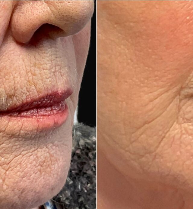 Dermal Fillers as a Non-Surgical Facelift Alternative